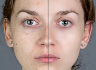 How To Get Rid Of Blemishes Overnight? how to get rid of blemishes overnight
