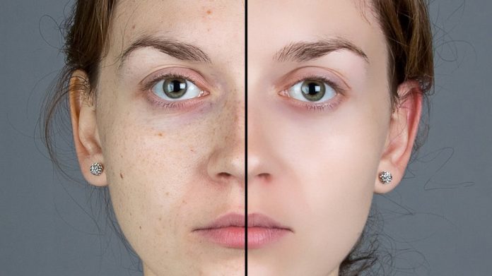 how-to-get-rid-of-blemishes how to get rid of blemishes overnight