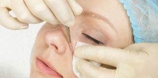 blackheads on nose