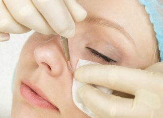 blackheads on nose