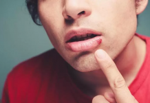 How To Get Rid Of Pimple On Lip Line Doesn’t Have To Be Hard. Use These 3 Simple Tips