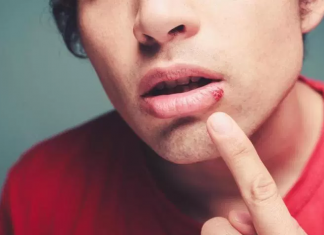 How To Get Rid Of Pimple On Lip Line Doesn’t Have To Be Hard. Use These 3 Simple Tips