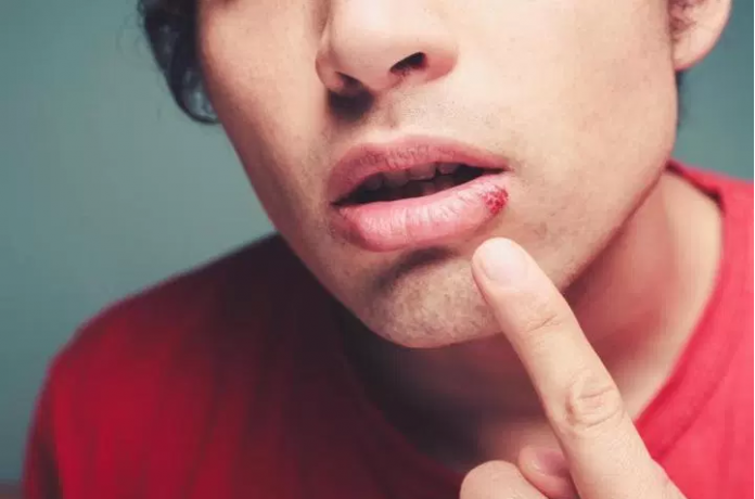 how-to-get-rid-of-pimple-on-lip